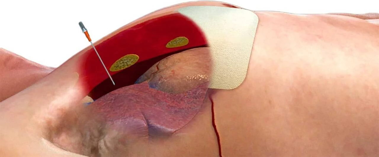 North American Rescue ARS Decompression Needle - NAR-ARS-ZZ-0298 North American Rescue ARS Decompression Needle - NAR-ARS-ZZ-0298 -Tactical Apparel Store north american rescue ars decompression needle nar ars zz 0298 nar ars zz 0298 43540.1601539624